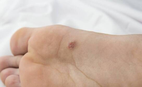 Diagnoza i terapia brodawek stóp - jak działa specjalista?