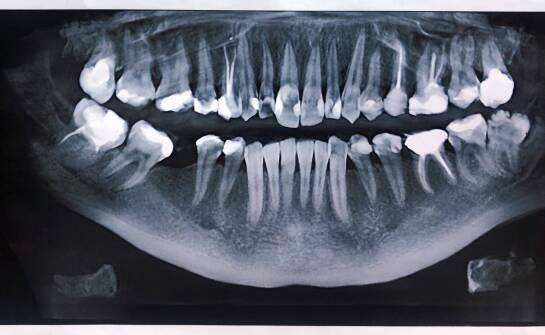 Jak RTG zębowe wspiera planowanie zabiegu podniesienia dna zatoki szczękowej?