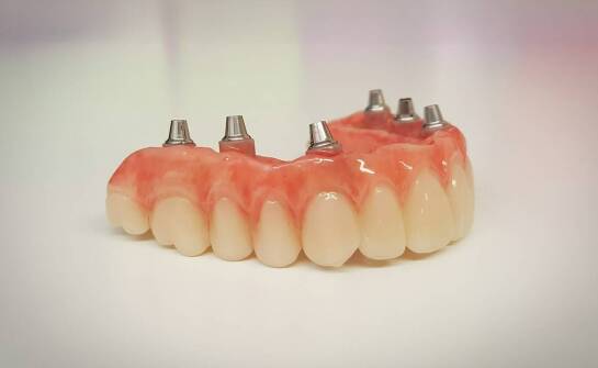 Dlaczego warto zainwestować w implanty zębowe? Kluczowe korzyści