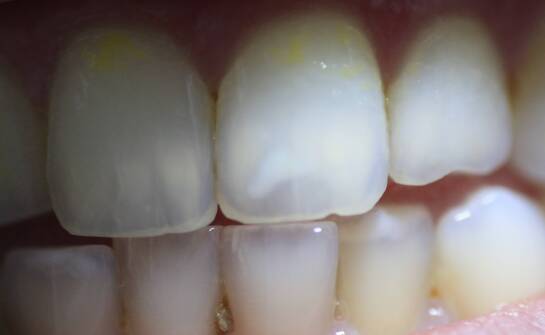 Białe przebarwienia na zębach - na co mogą wskazywać?