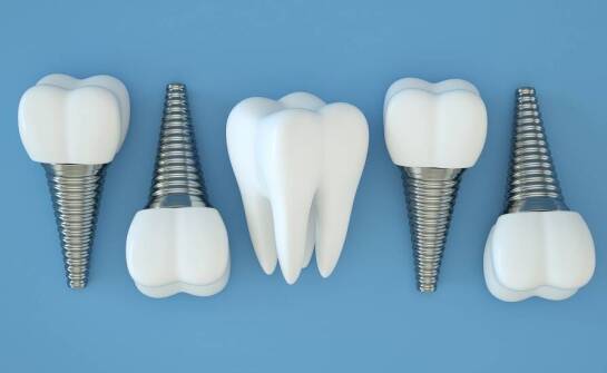 Przewaga implantów stomatologicznych nad tradycyjnymi protezami
