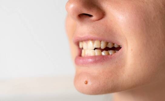 Jakie są rodzaje wad zgryzu?