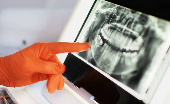 Co to jest rewizja leczenia kanałowego i kiedy jest potrzebna?