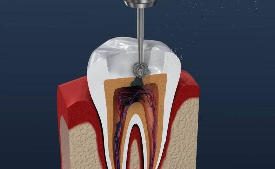 Jakie są najczęstsze problemy rozwiązywane przez leczenie kanałowe?