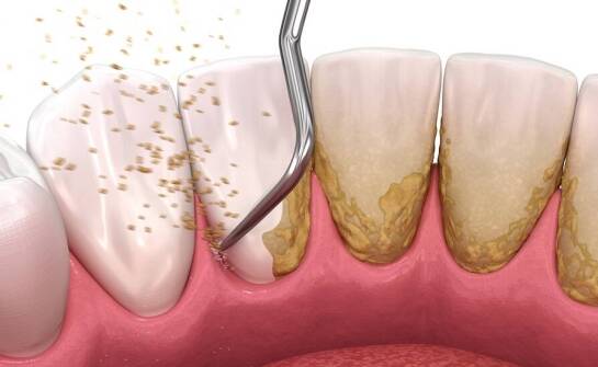 Jakie znaczenie ma skaling zębów dla zdrowia jamy ustnej?