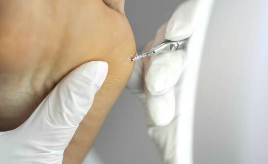 Usuwanie brodawek wirusowych w gabinecie podologicznym – na czym polega?