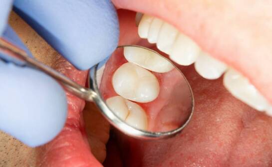 Leczenie kanałowe zębów – przebieg, wskazania i najważniejsze informacje