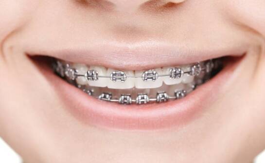 Wpływ aparatu ortodontycznego na poprawę funkcji zgryzu i mowy