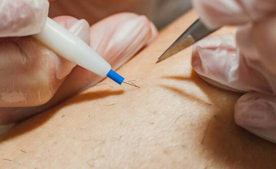 Mezoterapia igłowa Dr Cyj – efekty, wskazania i najważniejsze informacje