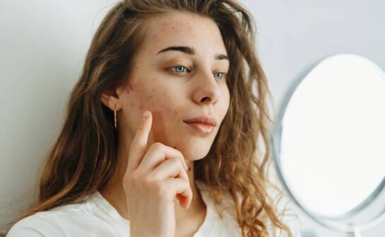 Najskuteczniejsze kwasy w walce z trądzikiem – rodzaje i zastosowanie