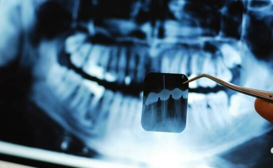 RTG zębów — kiedy wykonać zdjęcie i jak przebiega badanie radiologiczne