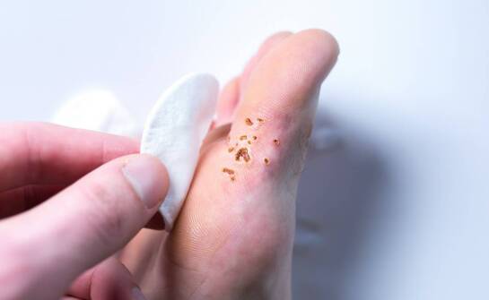 Jak skutecznie ograniczyć populację pcheł – praktyczne wskazówki i fakty