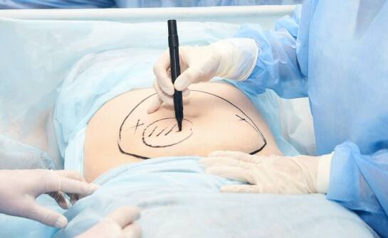 Jak przebiega abdominoplastyka i kto może skorzystać z zabiegu?