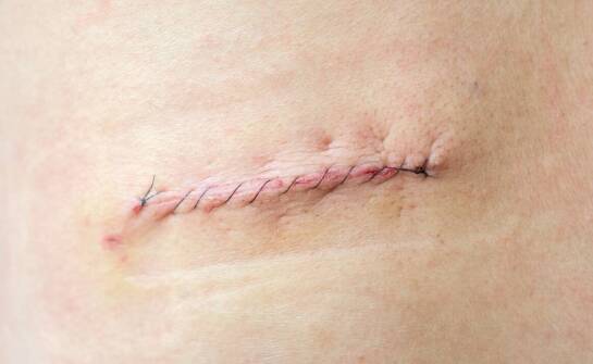 Nowoczesne metody leczenia żylaków – skuteczne rozwiązania i rezultaty