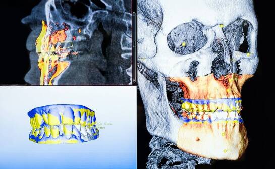 Tomografia komputerowa zębów – na czym polega i kiedy warto ją wykonać?