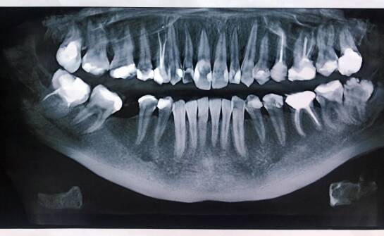 Zastosowania tomografii komputerowej zębów – wszystko, co warto wiedzieć