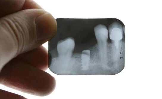 Tomografia komputerowa zębów – co warto wiedzieć o tym badaniu diagnostycznym