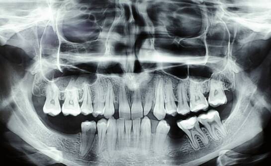 Tomografia komputerowa zębów – jak działa i kiedy może być niezbędna