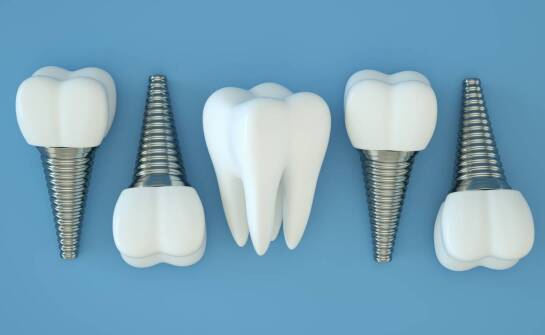 Implanty zębów – etapy leczenia oraz najważniejsze korzyści dla pacjentów