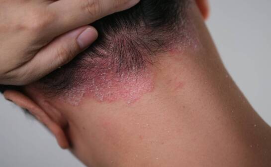 Grzybica skóry głowy – jak rozpoznać objawy i jak przebiega leczenie
