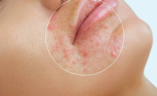 Atopowe zapalenie skóry – sprawdzone sposoby łagodzenia objawów i pielęgnacji