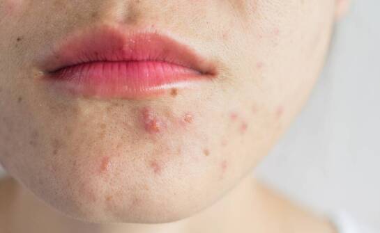 Nowoczesne metody walki z atopowym zapaleniem skóry – fakty i mity