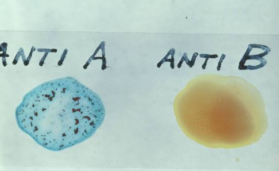 Bezocze – czym jest ta wada wzroku, przyczyny i najważniejsze objawy