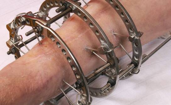 Protezowanie oczodołu – etapy, zastosowania i efekty leczenia okulistycznego