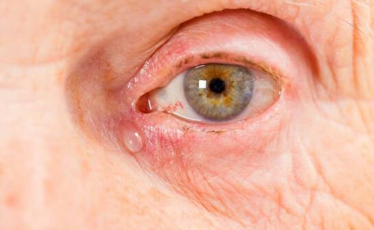 Czym są zatkane kanaliki łzowe? Objawy, przyczyny i możliwe sposoby leczenia