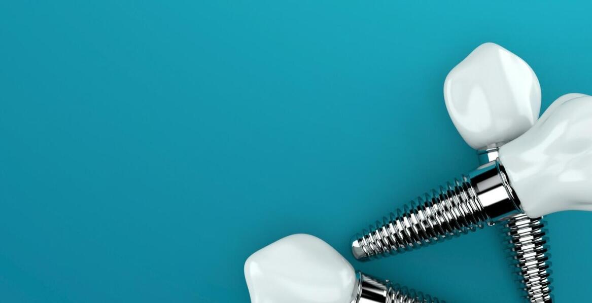 Implanty zębów – kiedy warto się zdecydować i co trzeba wiedzieć przed zabiegiem
