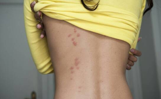 Warroza - jak ją zwalczać?