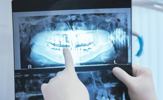 Rola RTG zębów w wykrywaniu próchnicy i chorób przyzębia