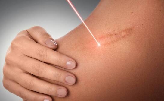 Innowacyjne podejście do usuwania blizn za pomocą technologii laserowej