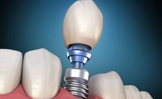 Zalety korzystania z nowoczesnych technologii w implantologii
