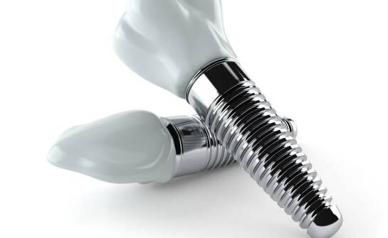 Dlaczego implanty zębowe są trwałym rozwiązaniem dla wielu pacjentów?