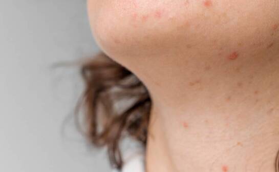 Hydrobrazja w kontekście pielęgnacji skóry trądzikowej – co warto wiedzieć?