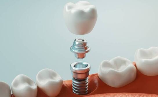 Jakie są przeciwwskazania do wszczepienia implantów dentystycznych?