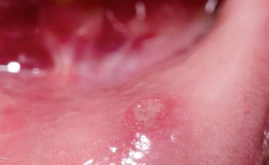 Torbiele w jamie ustnej: jak rozpoznać i leczyć problem chirurgicznie