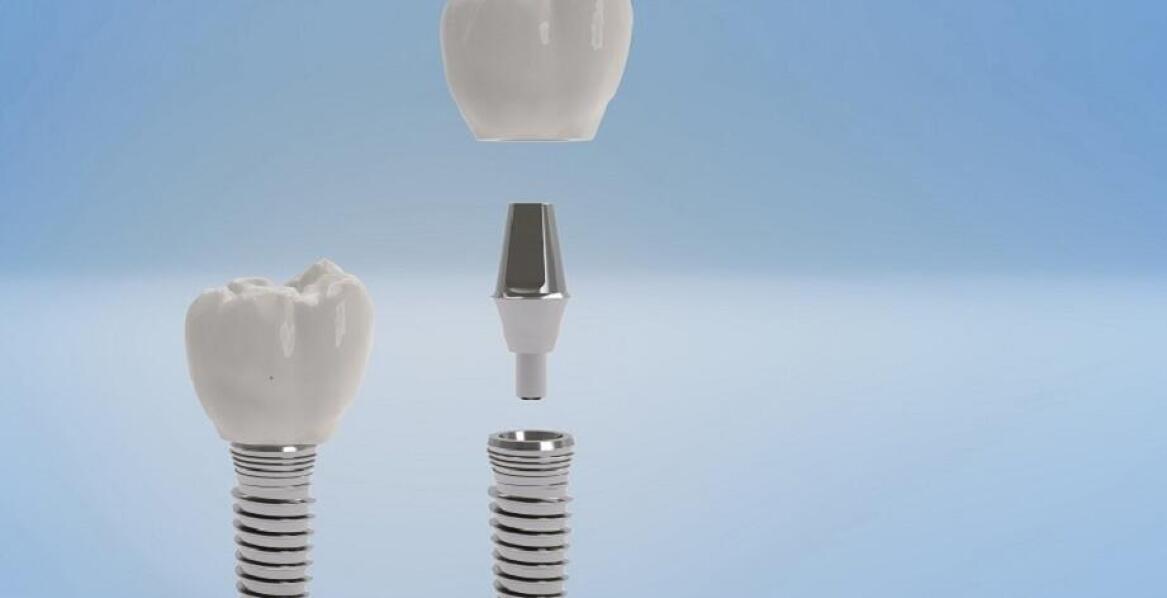 Implanty zębowe a inne metody uzupełniania braków zębowych