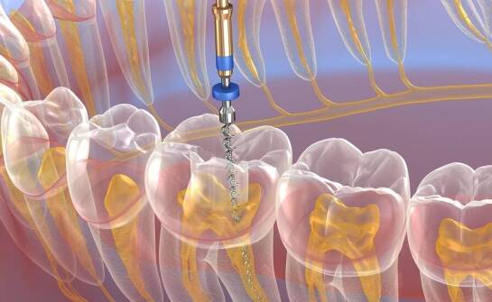 Bezbolesne zabiegi resekcji wierzchołka korzenia zęba dzięki nowoczesnym technologiom