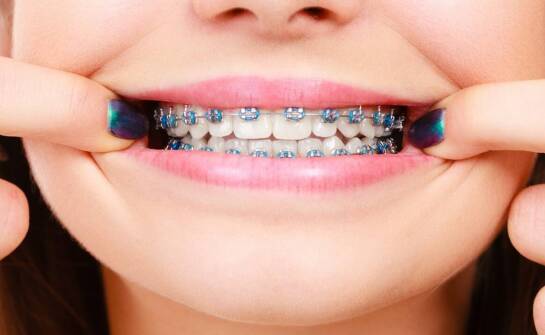 Czyściki do zębów i ich rola w zapobieganiu próchnicy u pacjentów ortodontycznych