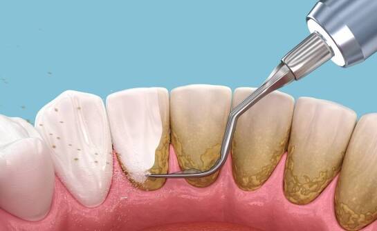 Czy mechaniczne usuwanie osadów może być całkowicie bezbolesne dla pacjenta z nadwrażliwością?