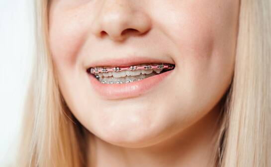Jakie metody stosowane są w leczeniu ortodontycznym u dzieci?