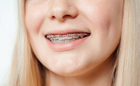 Aparat estetyczny – czy to dobry wybór dla dzieci?