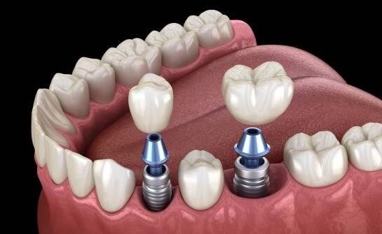 Dlaczego implanty zębowe są trwalsze niż tradycyjne protezy?