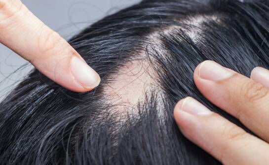 Znaczenie regularnych badań trychologicznych dla osób z grudkami na skórze głowy