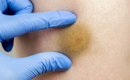 Jak hirudoterapia wpływa na redukcję stanów zapalnych w ciele