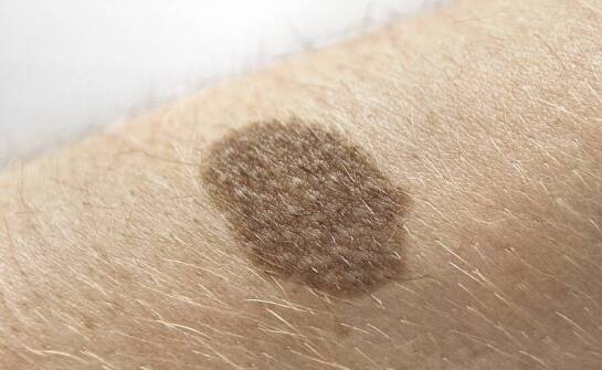 Jak gabinet medycyny estetycznej może pomóc w usuwaniu przebarwień skóry?