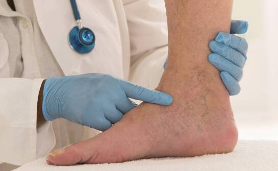 Rola flebologa w procesie leczenia powierzchownego zapalenia zakrzepowego żył