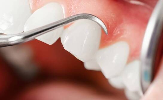 Dlaczego warto skorzystać z usług periodontologa w przypadku chorób dziąseł?